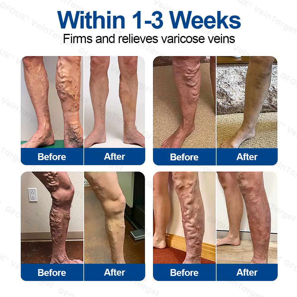 🇺🇸👨‍⚕️✨🌿𝐇𝐞𝐚𝐥𝐫𝐢𝐳𝐞® VeinTarget Microneedle Patch⚡Instant Relief, Long-Term Results